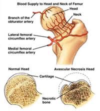 hip avascular necrosis image 1