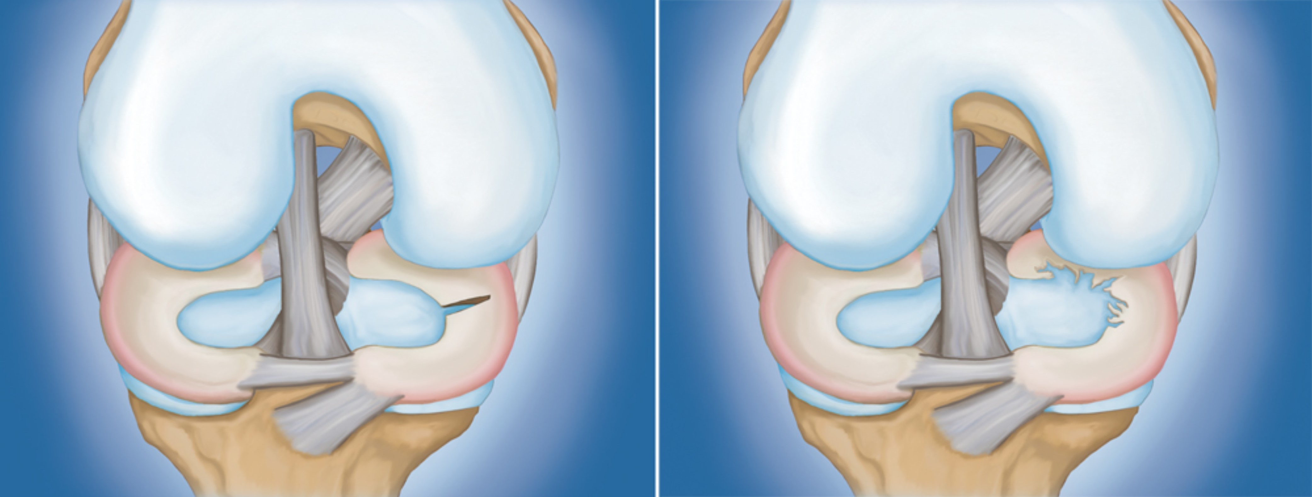 Meniscal tears 2