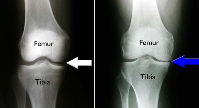 Osteotomy Of The Knee 1