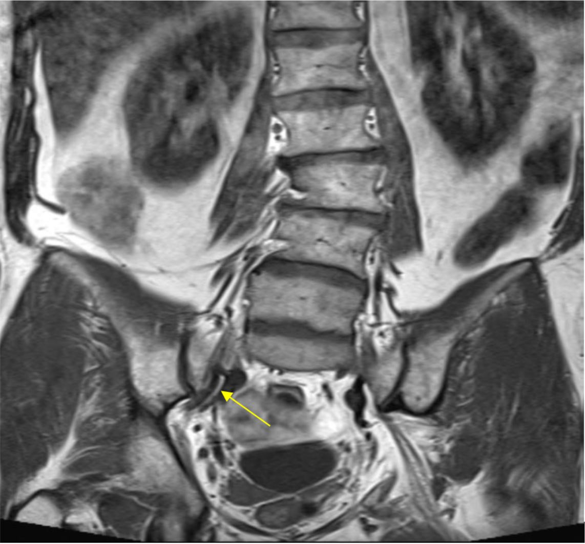 Anatomy And Biomechanics Of The Sacroiliac Joint 8b