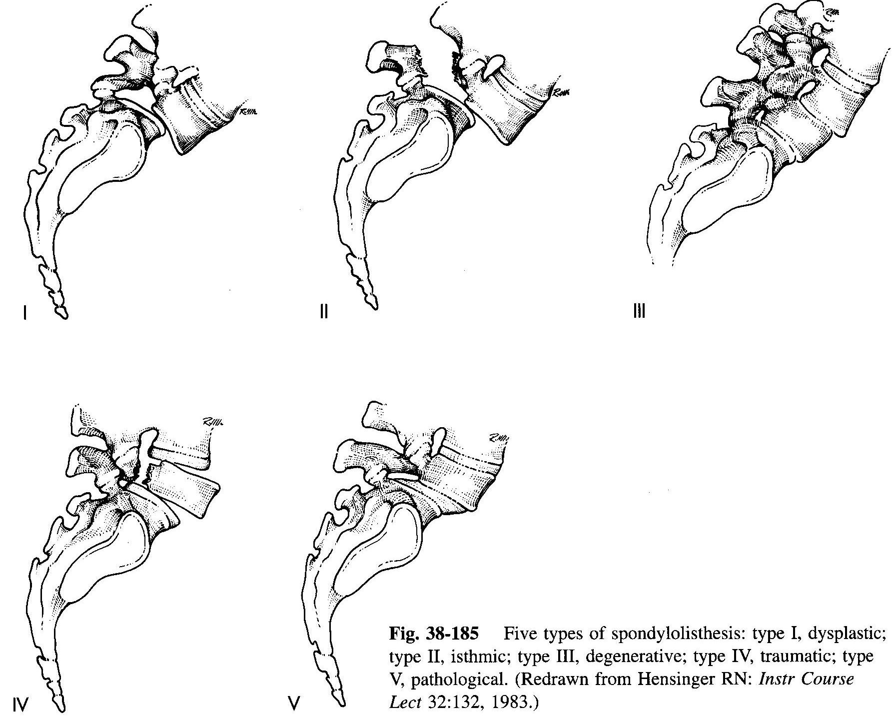 Spondylolisthesis and Spondylolysis 1