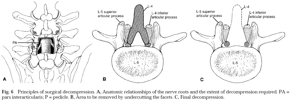 Spondylolisthesis and Spondylolysis 2